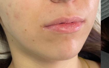 Lip Enhancement Before & After Patient #12175