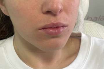 Lip Enhancement Before & After Patient #12117