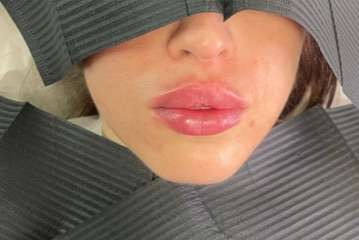 Lip Enhancement Before & After Patient #12117