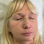 Lip Enhancement Before & After Patient #12176