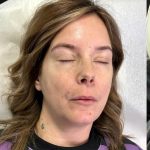 Lip Enhancement Before & After Patient #12181