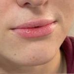 Lip Enhancement Before & After Patient #12120