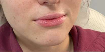 Lip Enhancement Before & After Patient #12120