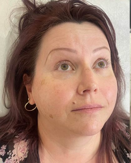 Lip Enhancement Before & After Patient #12242