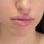Lip Enhancement Before & After Patient #12141