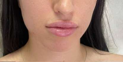 Lip Enhancement Before & After Patient #12141