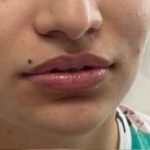 Lip Enhancement Before & After Patient #12142