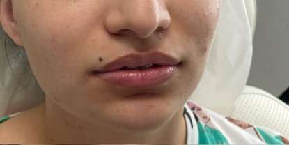 Lip Enhancement Before & After Patient #12142