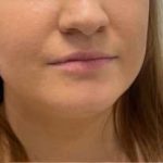 Lip Enhancement Before & After Patient #12143