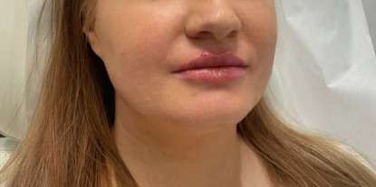 Lip Enhancement Before & After Patient #12143