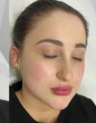 Lip Enhancement Before & After Patient #12244