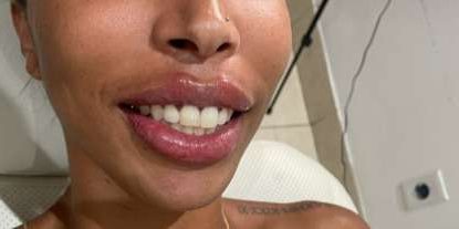 Lip Enhancement Before & After Patient #12146