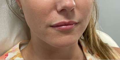 Lip Enhancement Before & After Patient #12147