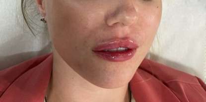 Lip Enhancement Before & After Patient #12147