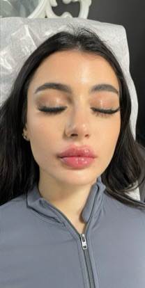 Lip Enhancement Before & After Patient #12249