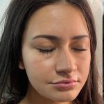 Lip Enhancement Before & After Patient #12253