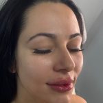 Lip Enhancement Before & After Patient #12254