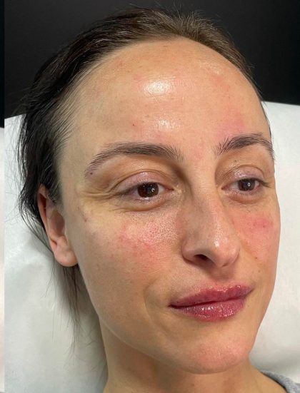 Lip Enhancement Before & After Patient #12256