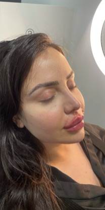 Lip Enhancement Before & After Patient #12257