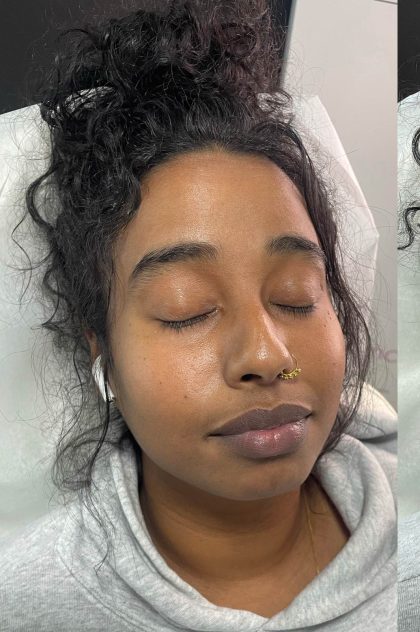 Lip Enhancement Before & After Patient #12258