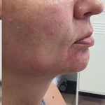 Non-Surgical Facelift Before & After Patient #12901