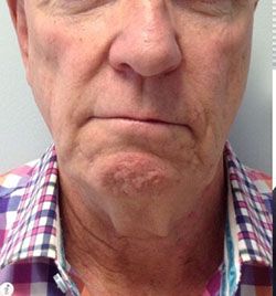 Skin Tightening Before & After Patient #12903