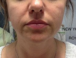 Skin Tightening Before & After Patient #12909