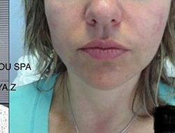 Skin Tightening Before & After Patient #12909