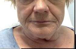 Skin Tightening Before & After Patient #12905