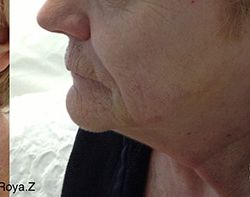 Skin Tightening Before & After Patient #12905