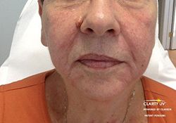 Skin Tightening Before & After Patient #12907