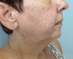 Skin Tightening Before & After Patient #12907