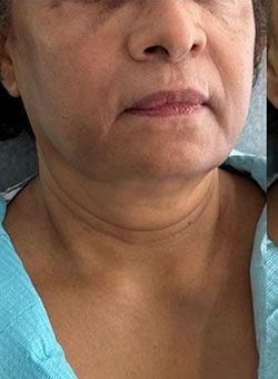 Non-Surgical Facelift Before & After Patient #12910
