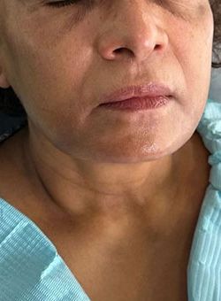Non-Surgical Facelift Before & After Patient #12910