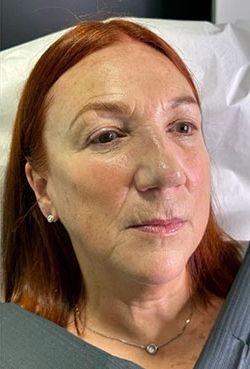 Non-Surgical Facelift Before & After Patient #12911