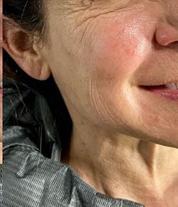 Skin Tightening Before & After Patient #12890