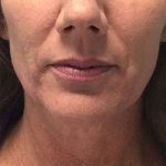 Non-Surgical Facelift Before & After Patient #12895