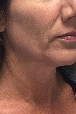 Non-Surgical Facelift Before & After Patient #12895