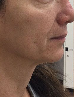 Non-Surgical Facelift Before & After Patient #12906