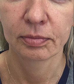 Non-Surgical Facelift Before & After Patient #12901