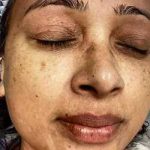Microneedling Before & After Patient #13273