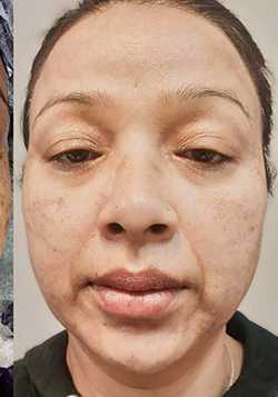 Microneedling Before & After Patient #13273