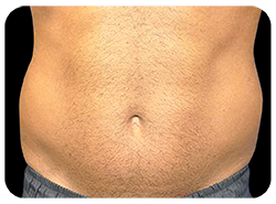 EMBodiSculpt Before & After Patient #13756