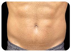 EMBodiSculpt Before & After Patient #13756