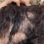 Hair Restoration Before & After Patient #13483