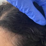 Hair Restoration Before & After Patient #13483