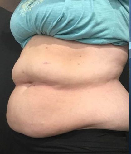 EMBodiSculpt Before & After Patient #13774
