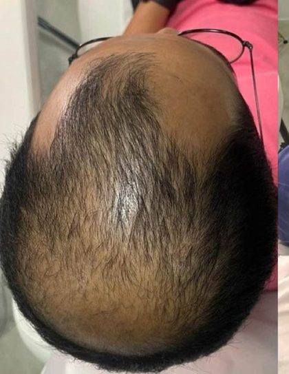Hair Restoration Before & After Patient #13473