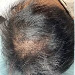 Hair Restoration Before & After Patient #13427