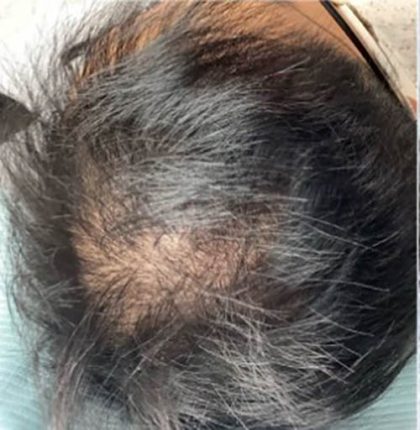 Hair Restoration Before & After Patient #13427